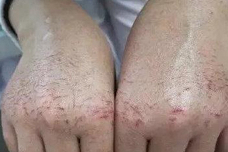干性湿疹手背皲裂图