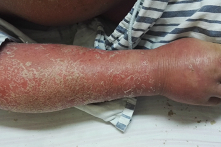 红皮病型银屑病胳膊脱屑图 红皮病型银屑病胳膊脱屑图