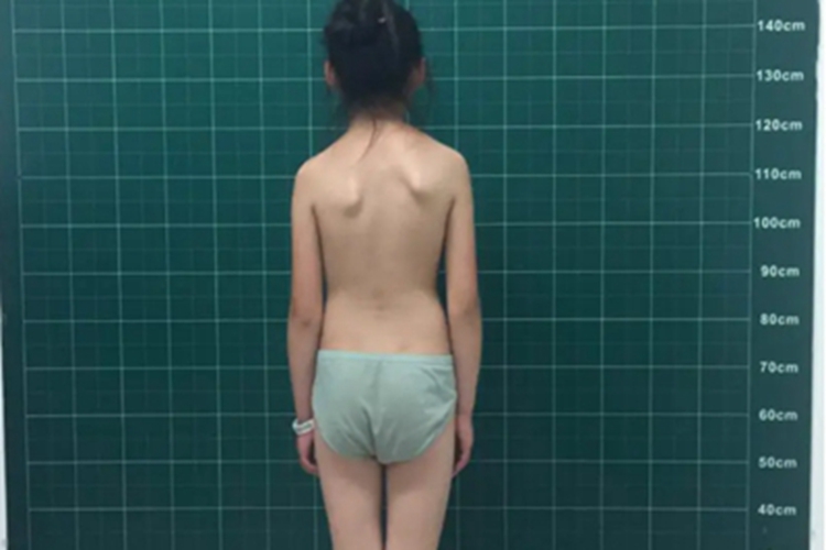 脊柱侧凸双肩不等高图