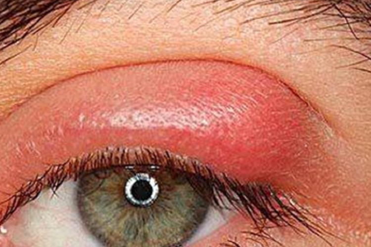 外睑腺炎眼睑红肿图