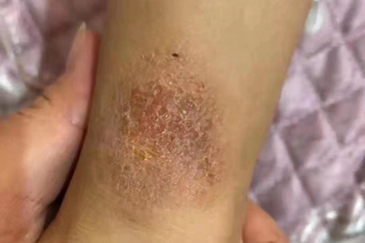 急性湿疹黄痂图 急性湿疹黄痂图