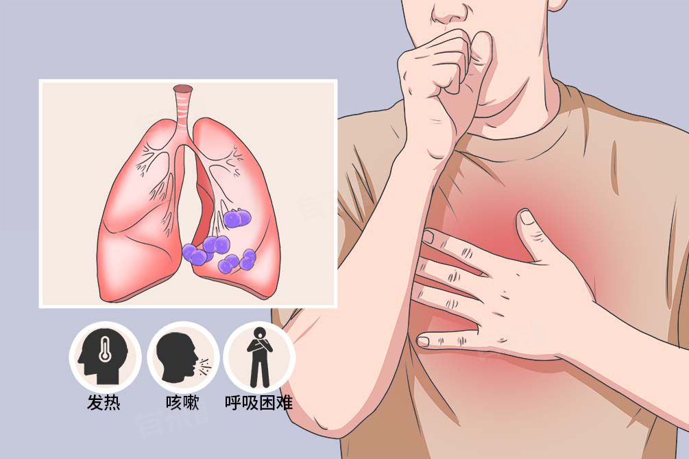 肺炎是什么引起的,有哪些症状