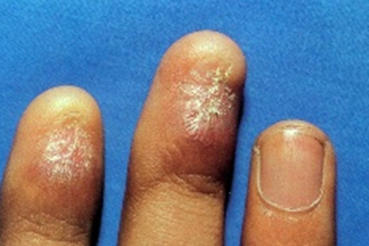 甲胬肉手指甲缩小图 甲胬肉手指甲缩小图