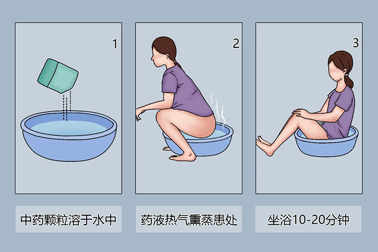 痔疮正确坐浴图