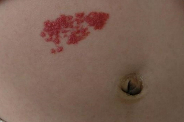 毛细血管瘤软疙瘩图 毛细血管瘤软疙瘩图