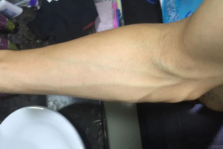 胳膊静脉曲张血管鼓包图