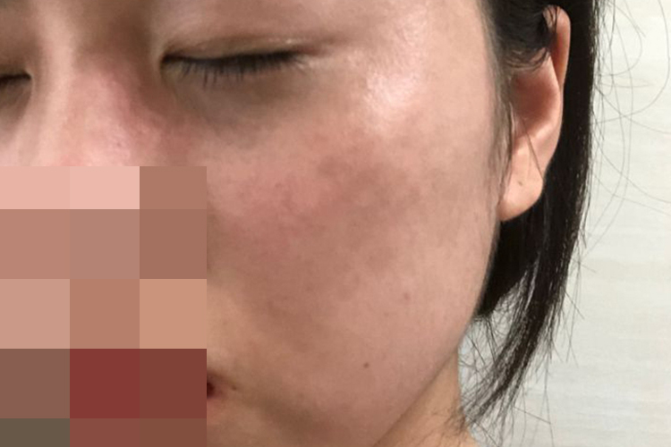 太田痣激光后潮红图