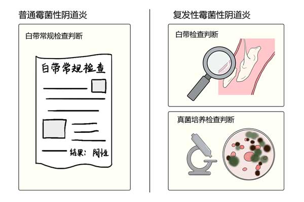 单纯霉菌性阴道炎患者治疗结束后没有症状,白带常规检查阴性为治愈