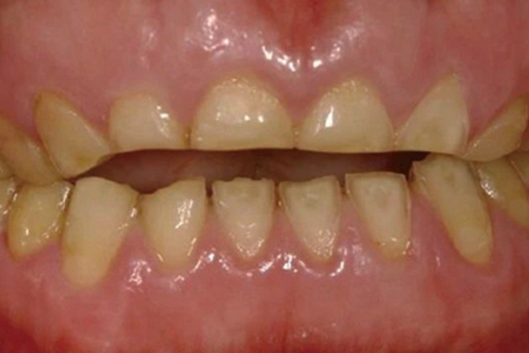 酸蚀症牙齿有一列缺损图 酸蚀症牙齿有一列缺损图