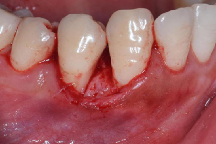 剥离肿瘤图 剥离肿瘤图