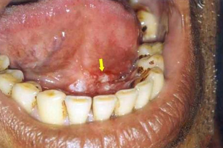 口腔癌下腭内壁硬包图