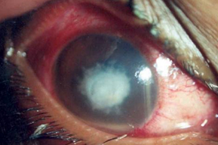棘阿米巴角膜炎黑眼球有白斑图