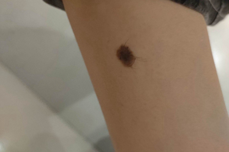 复合痣胳膊症状图 复合痣胳膊症状图