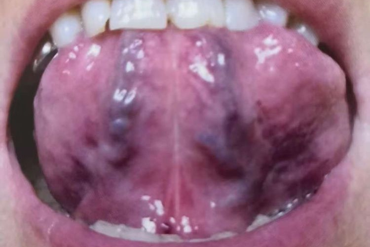 舌下静脉曲张图