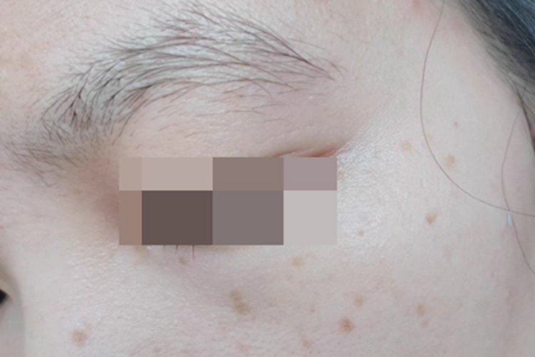雀斑面部长褐色斑图