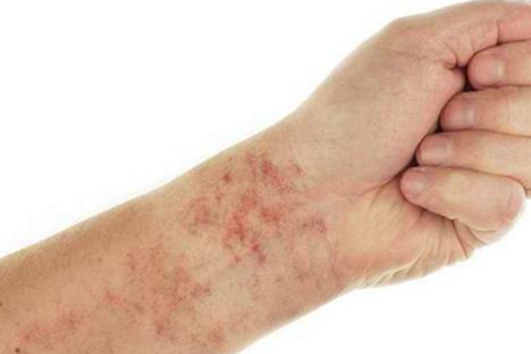 血栓性血小板减少性紫癜红斑图 血栓性血小板减少性紫癜红斑图