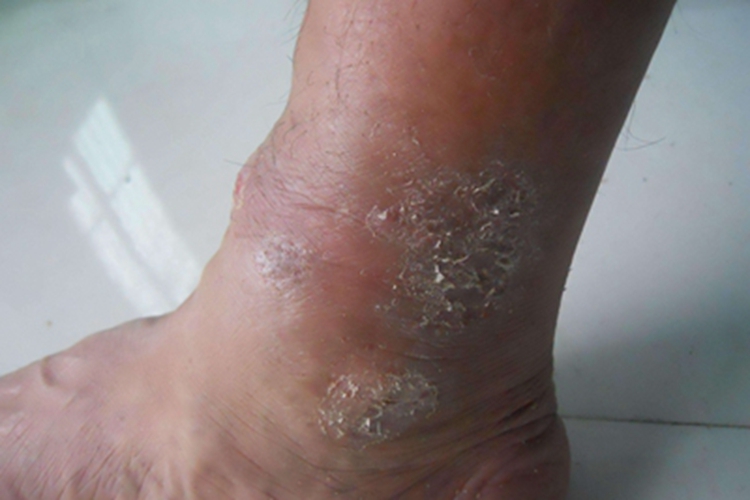 银屑病关节炎脚踝脱皮图 银屑病关节炎脚踝脱皮图