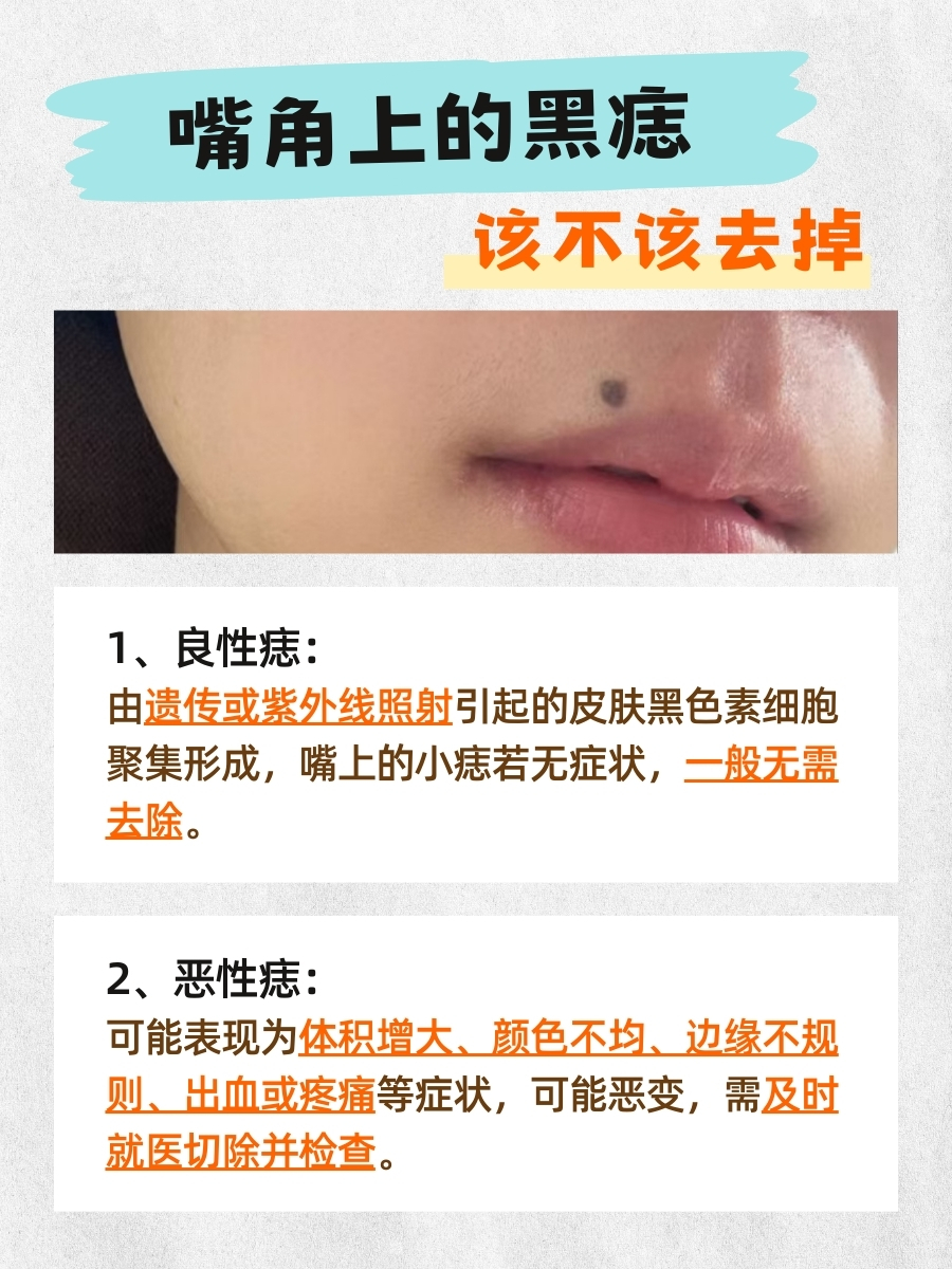 医生解答：嘴角上的黑痣该不该去掉