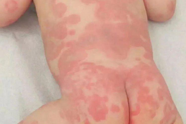 感染性荨麻疹后背长大片红斑图