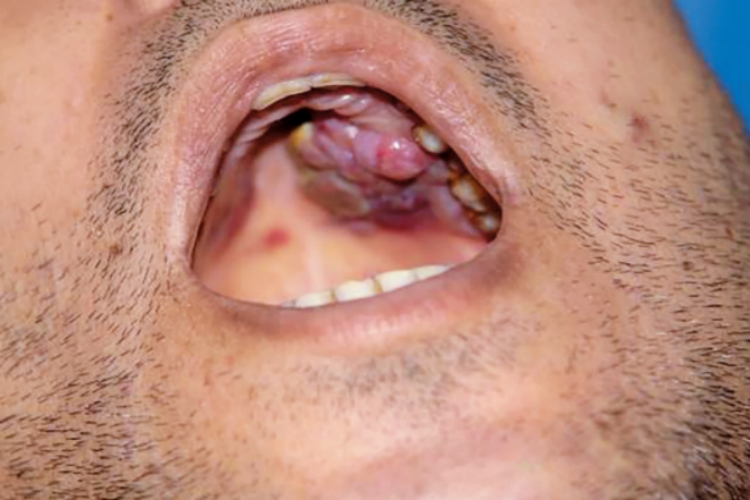 口腔卡波西肉瘤图片