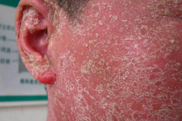 儿童红皮病型银屑病图 儿童红皮病型银屑病图
