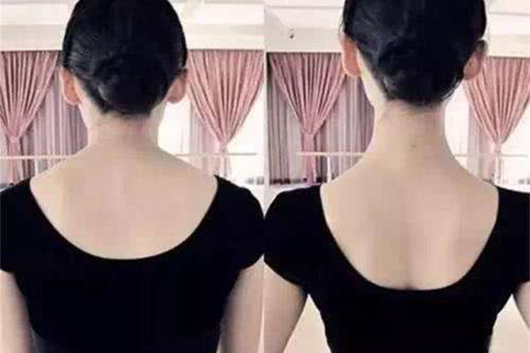 女生斜方肌太厚与正常斜方肌对比图 女生斜方肌太厚与正常斜方肌对比图