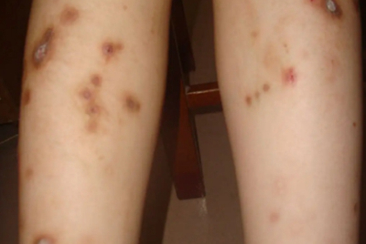 皮肤猪囊虫病小腿结痂图 皮肤猪囊虫病小腿结痂图