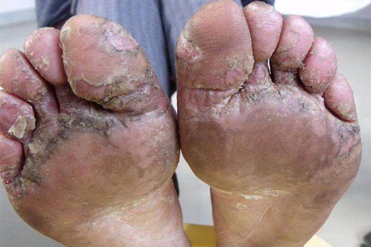 鳞屑角化型足癣脱皮图