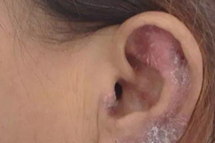 冻疮样红斑狼疮耳廓覆白痂图