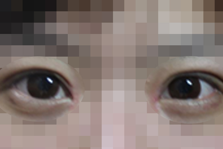 开眼角术后第7天恢复图