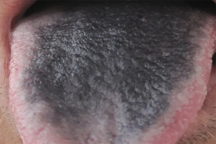 灰黑苔病在肾图 灰黑苔病在肾图