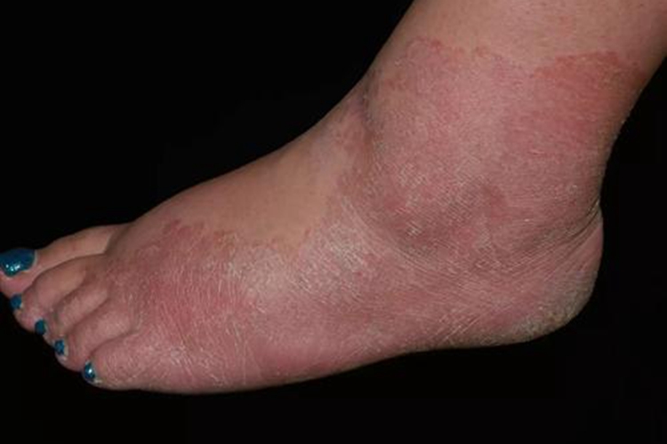 鳞屑角化型足癣脚踝红斑图