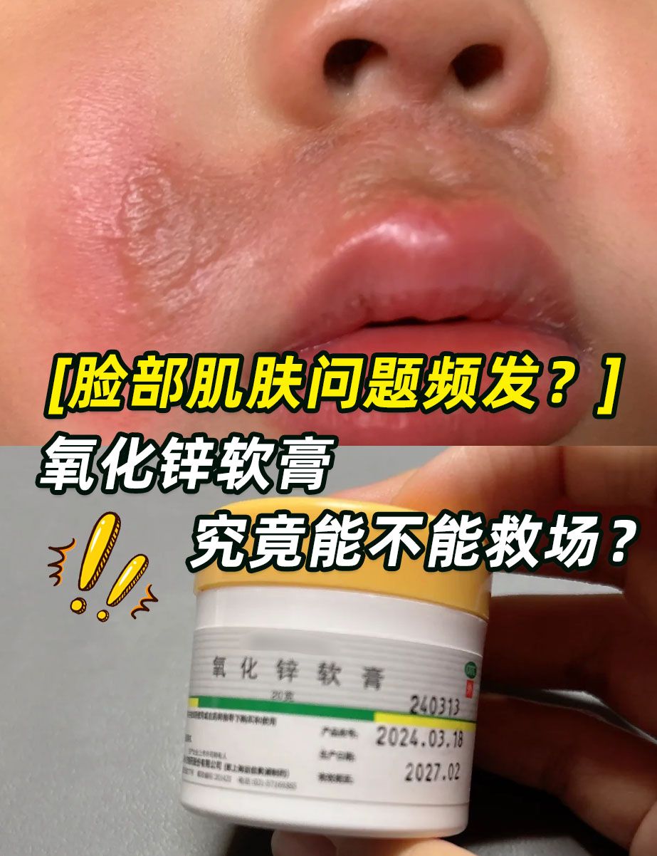 脸部肌肤问题频发?氧化锌软膏究竟能不能救场?