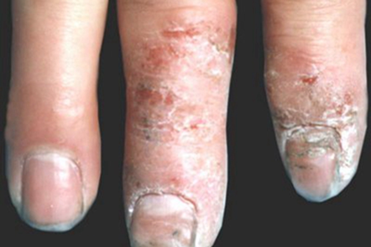 皮革皮炎手指结痂图