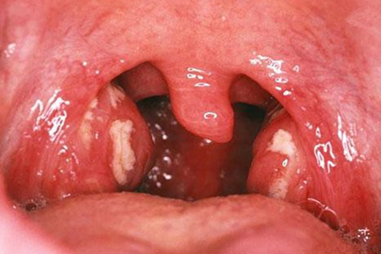 双侧扁桃体炎图