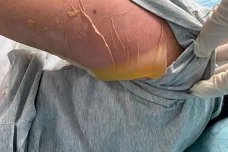 中毒性表皮坏死松解症胳膊症状图 中毒性表皮坏死松解症胳膊症状图