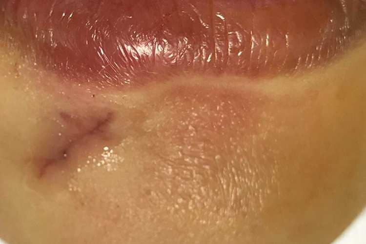 黑色素痣手术切除后图