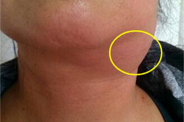 鼠疫颈部症状图