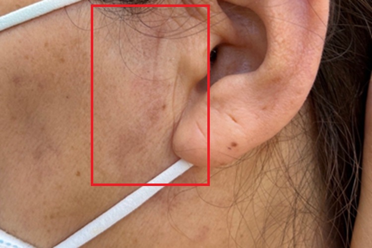 脂溢性皮炎耳前红斑图