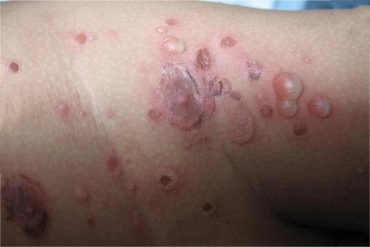 大疱性脓疱疮腹部症状图