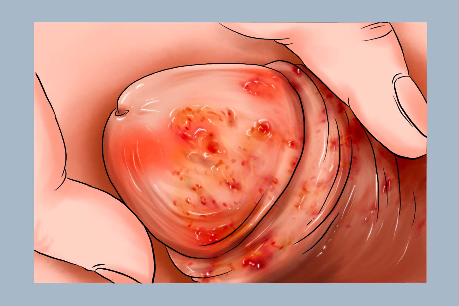 滴虫性龟头炎阴茎手绘图