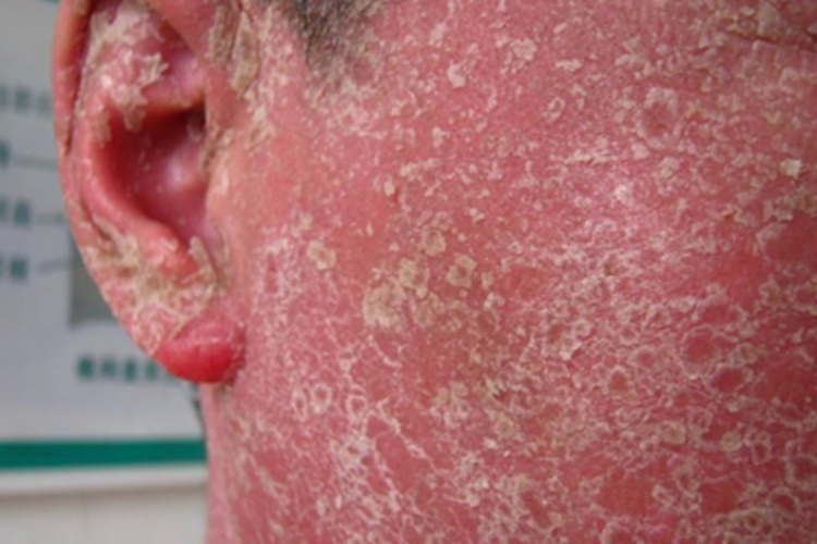 红皮病型银屑病面部脱屑图 红皮病型银屑病面部脱屑图