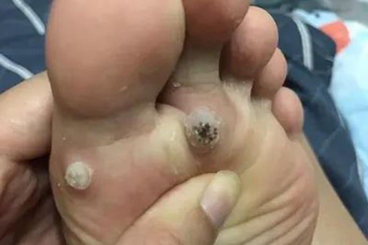 寻常疣脚底有圆形硬块图