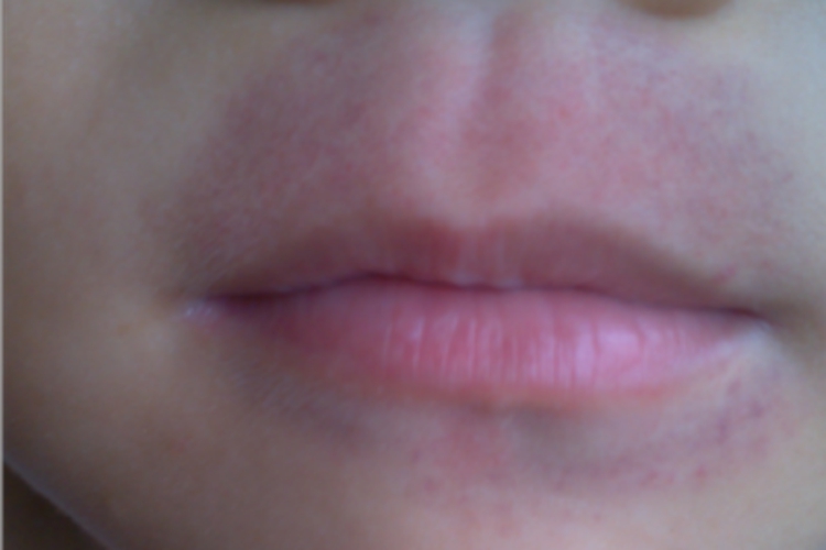 口周皮炎口周红点图