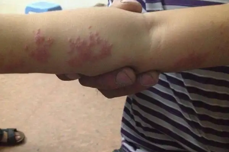 带状疱疹手臂内侧长红疹图