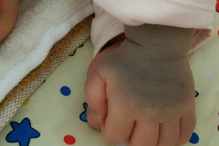 色素型胎记手部斑图