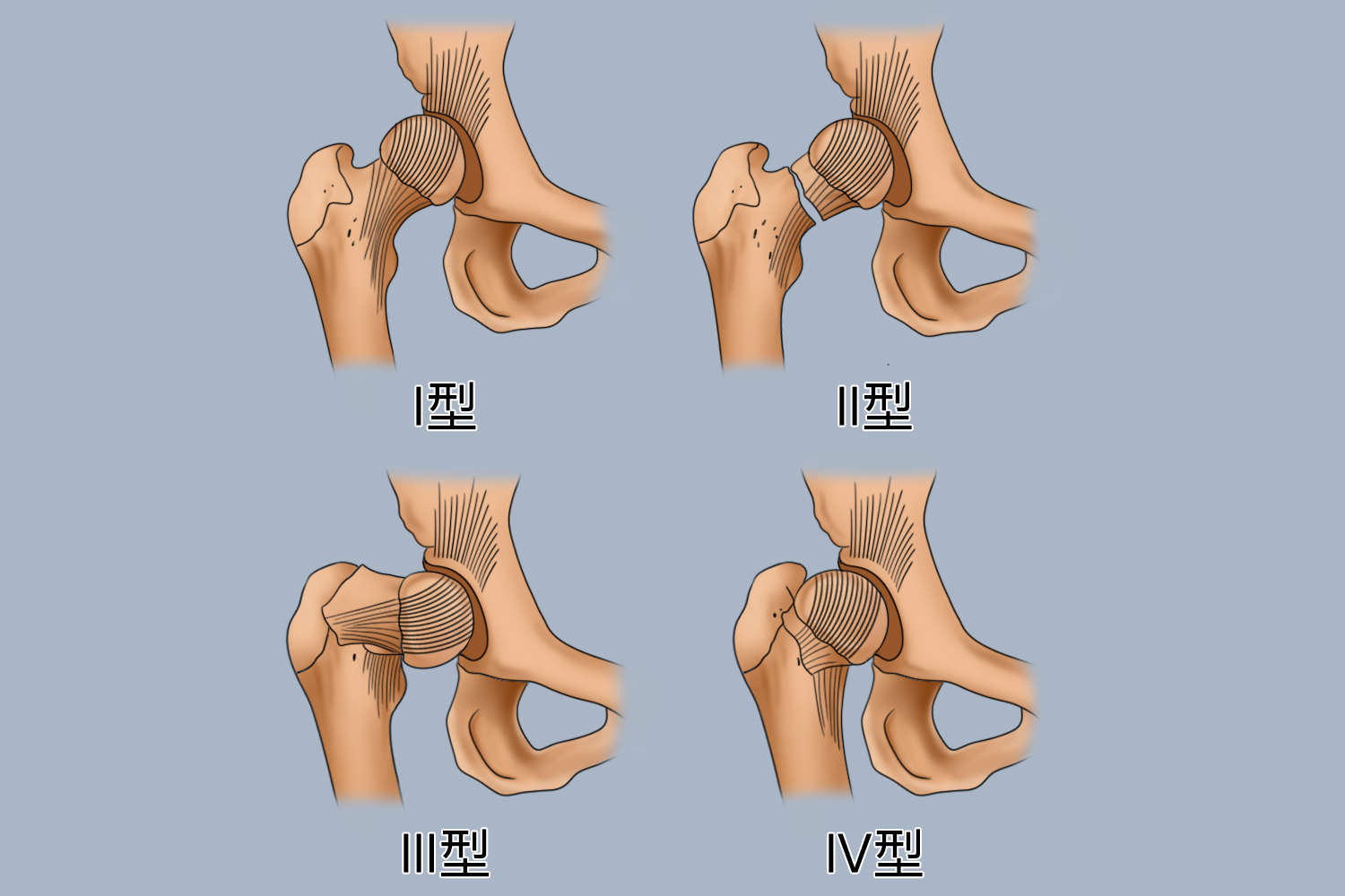 股骨颈骨折Garden分型图