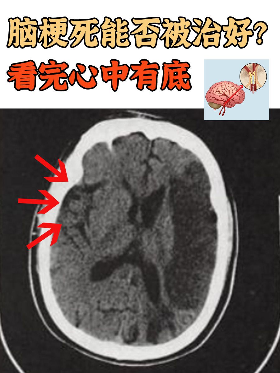 脑梗死能否被治好?看完心中有底