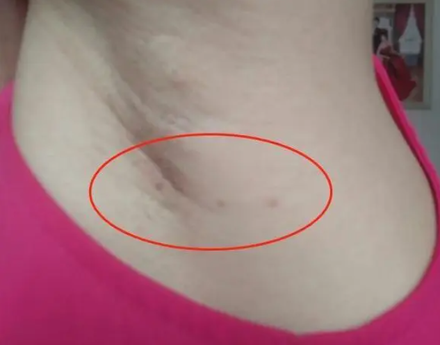 小女孩腋下长小肉粒寻常疣图