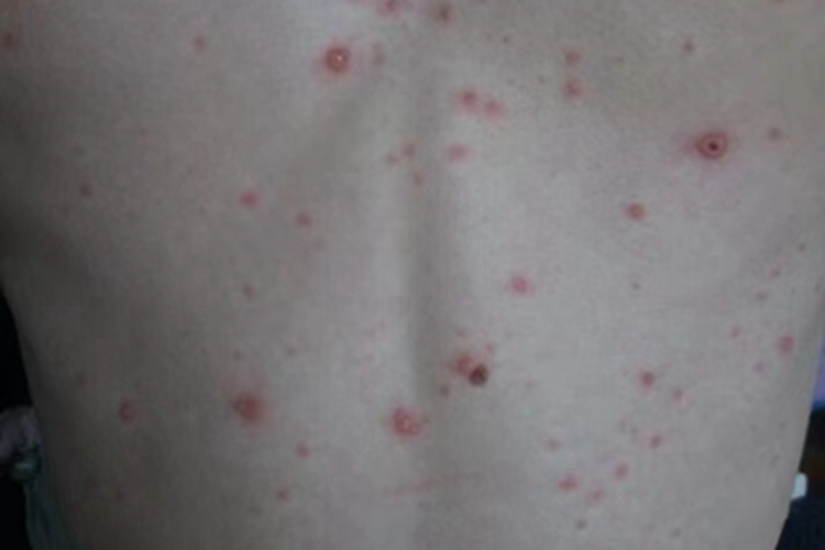 水痘胸部红色丘疹图 水痘胸部红色丘疹图
